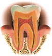 歯周炎(中等度)